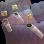 MagNeoFit Telescopic-Magnetic Abutments - Image 2